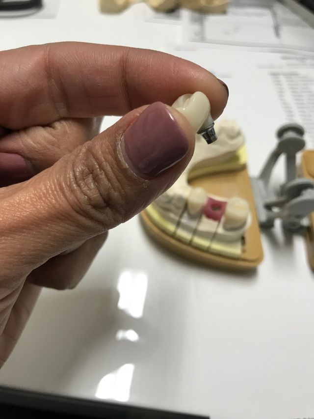 Dental Implants to Restore Confidence and Function: Benefits and Patient Guide