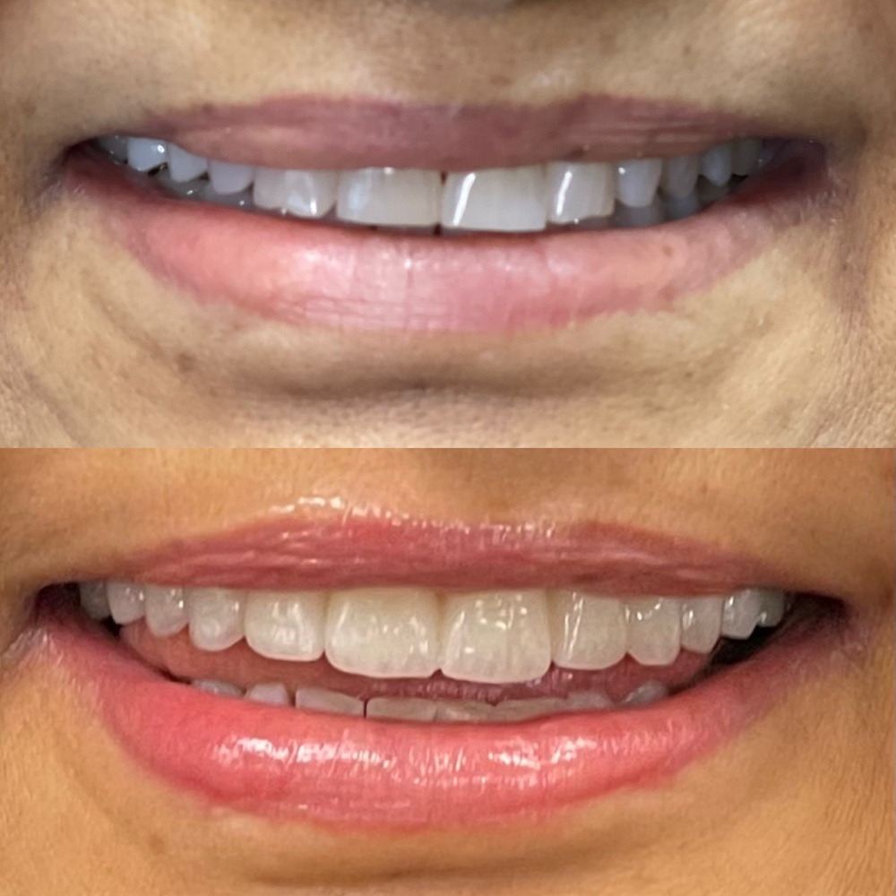 Arestin periodontal treatment before and after results